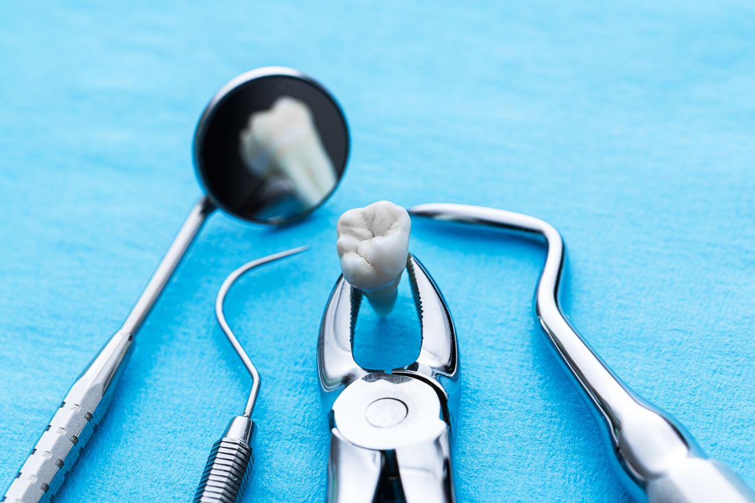 Tooth Extraction San Antonio, TX